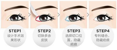 开外眼角
